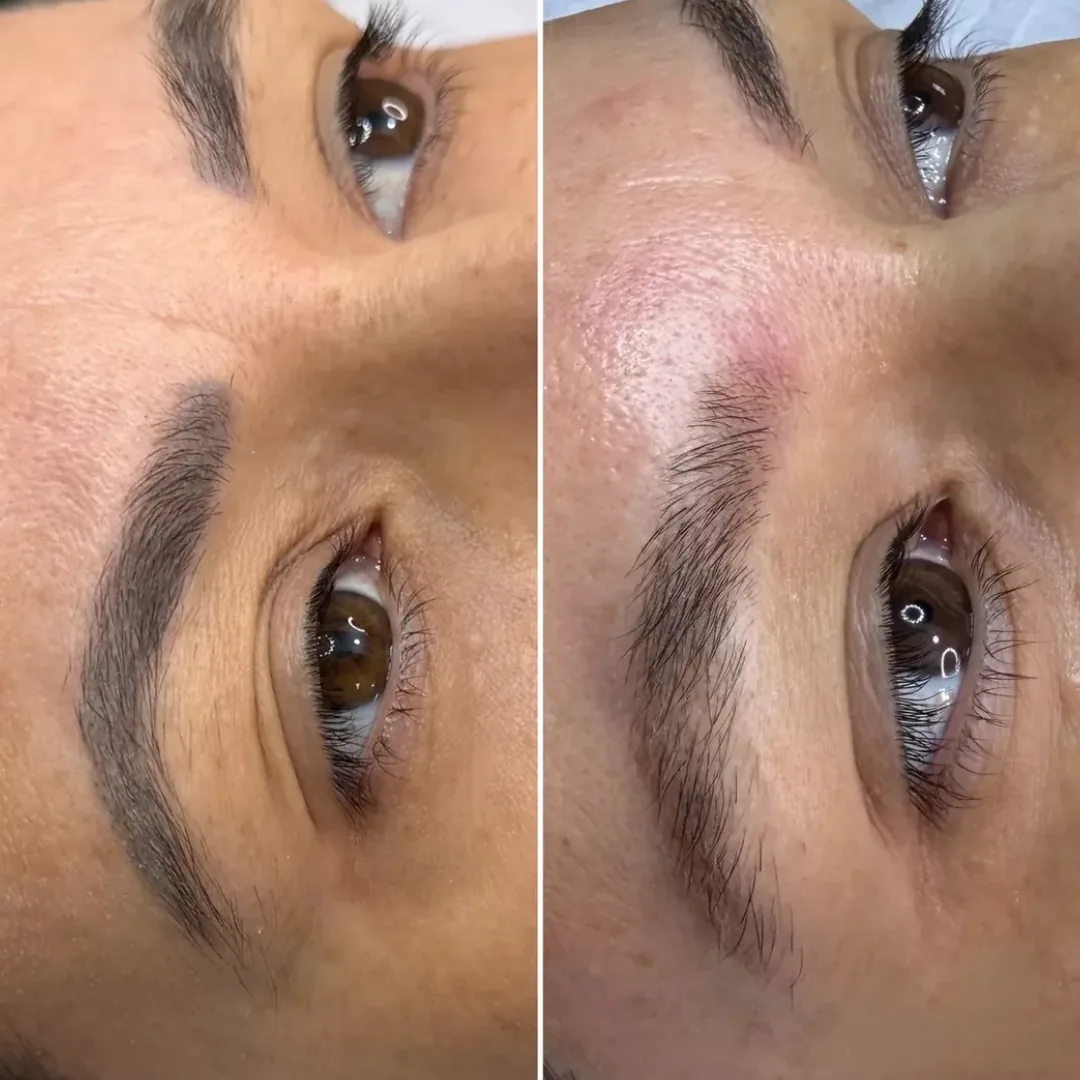 Sobrancelha antes e depois de remoção de micropigmentação a laser dentro de um plano de reconstrução, com clareamento parcial do pigmento antigo