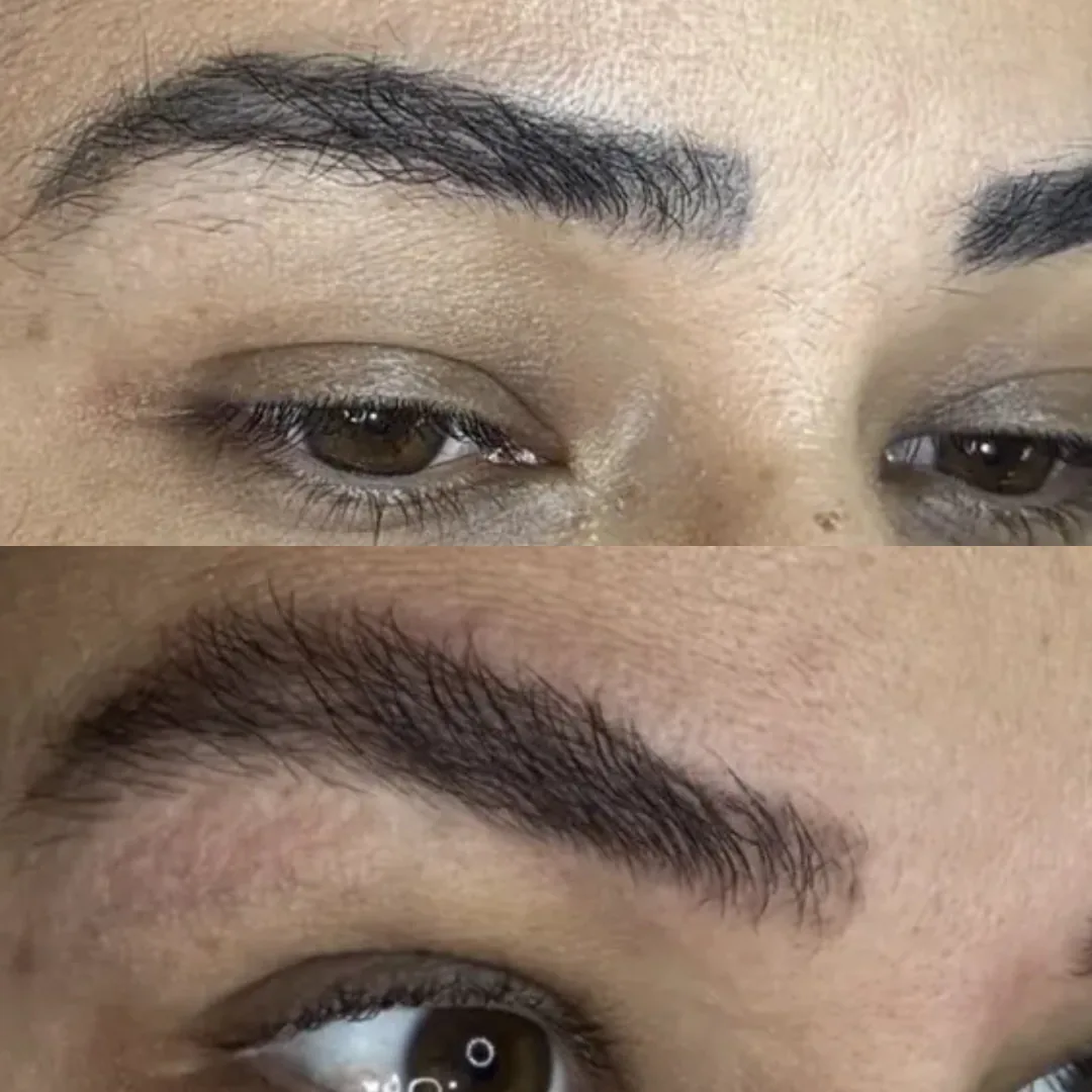 Sobrancelha antes e depois de remoção de micropigmentação com reconstrução: acima, o bloco de pigmento antigo; abaixo, o desenho recomposto com aspecto de fios