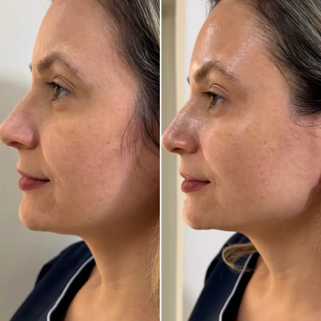 Perfil do rosto antes e depois de Ultraformer para firmeza facial