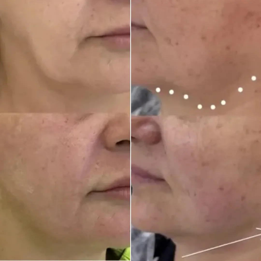 Perfil de rosto e pescoço antes e depois de Ultraformer na região da papada, com marcações da área tratada